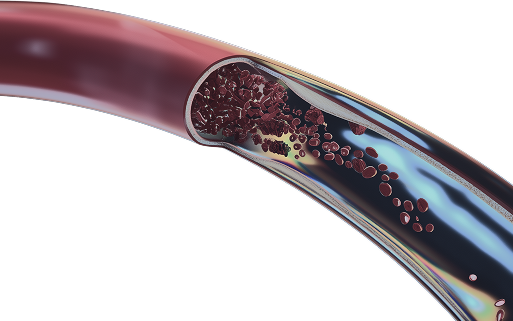 Лікування судинних патологій